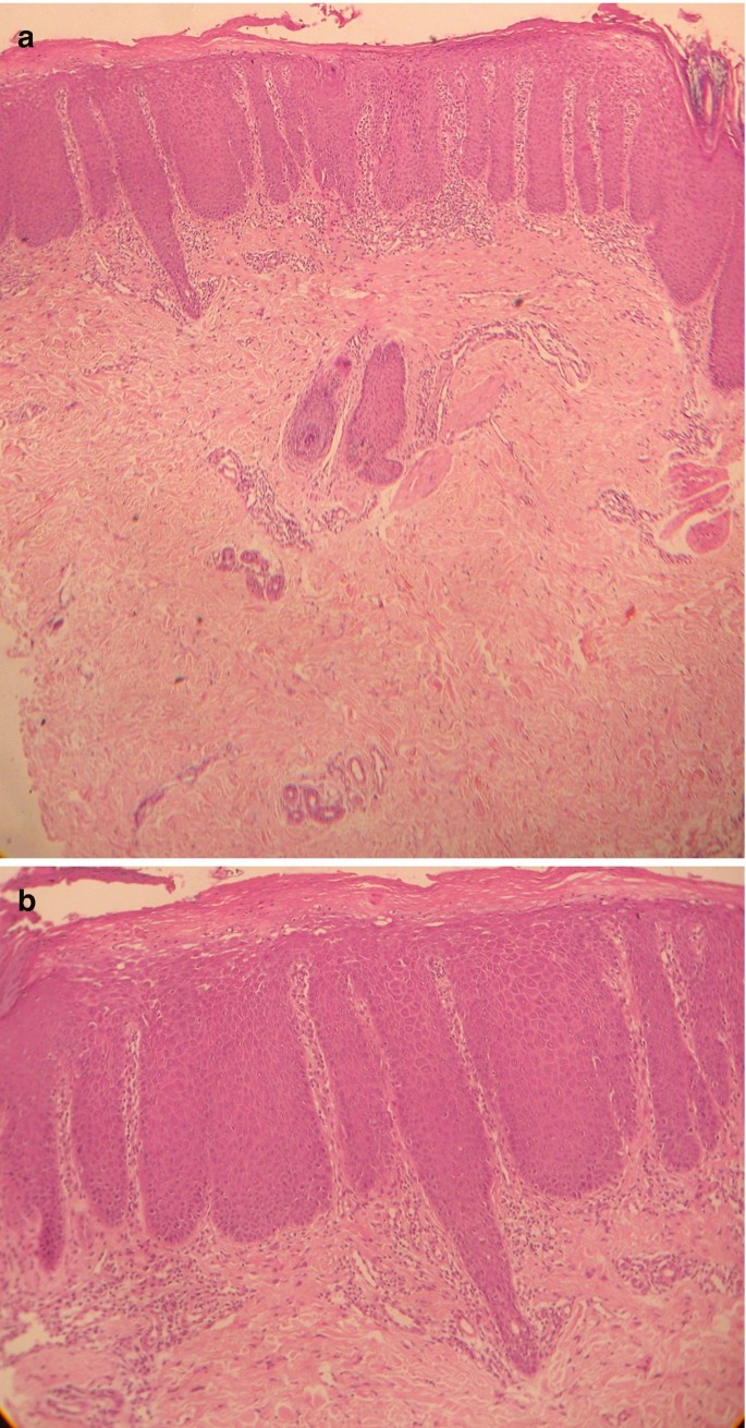 The Genital, Perianal, and Umbilical Regions | SpringerLink