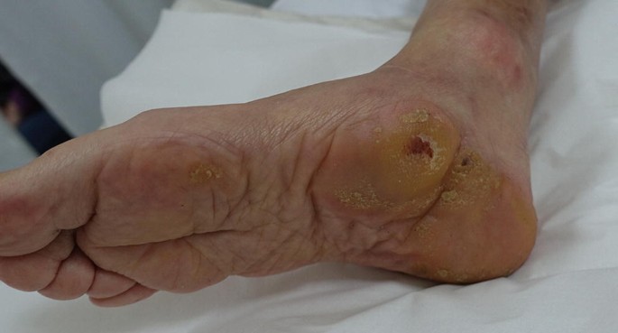 Foot Scrubber To Remove Dead Skin & Calluses With Nanometer Glass