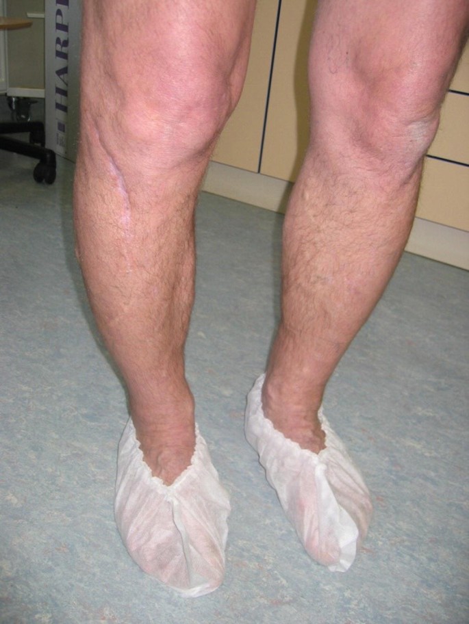 Right calf with swelling and induration of skin at presentation.