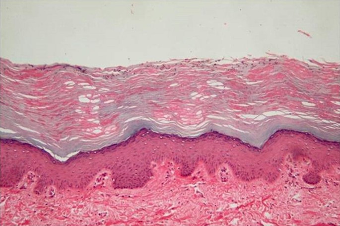 Tinea nigra pathology