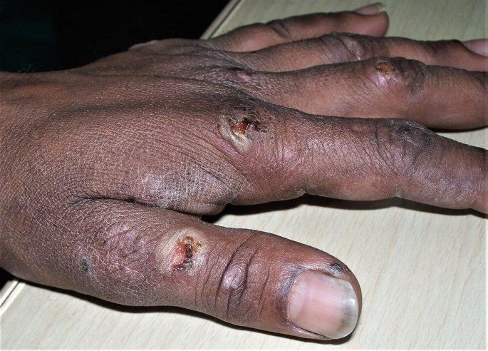 Tropical Diseases of the Skin