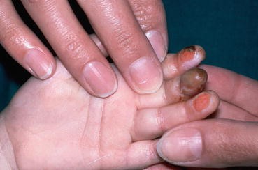 cigarette burn on finger Burns