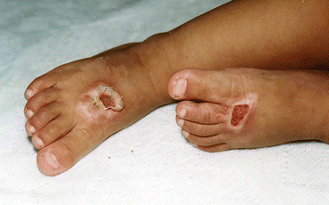 what does cigarette burn look like Burns