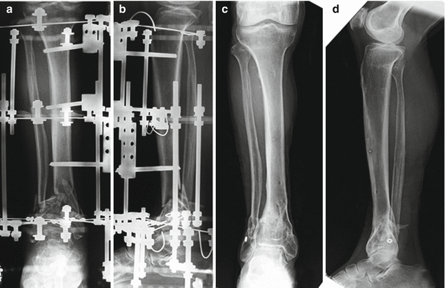 Full ring external fixation (Ilizarov) for Extraarticular, wedge