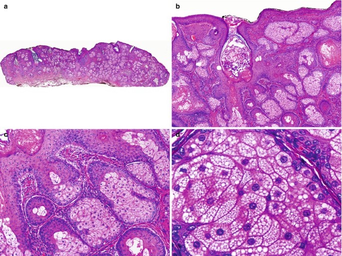 Sebaceous Hyperplasia and Rhinophyma | SpringerLink