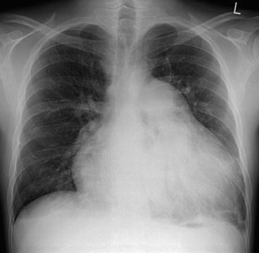 Bronchiectasis - CXR and CT - Radiology at St. Vincent's University Hospital