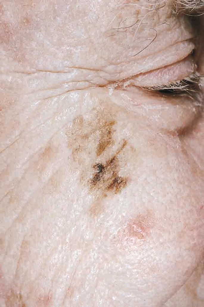 Diffuse Melanosis Cutis