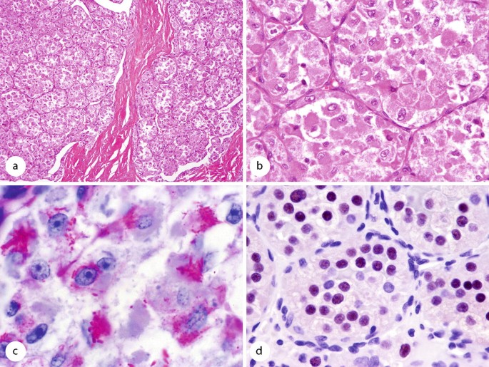 High-power view of fibrous area with ropey collagen bundles and