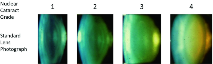 Semantic Reconstruction-Based Nuclear Cataract Grading from Slit-Lamp Lens  Images | SpringerLink