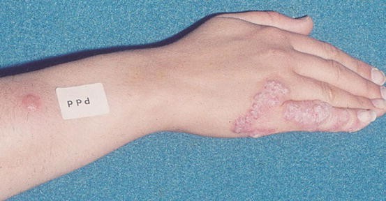 Mycobacterium bovis Skin Infection | SpringerLink