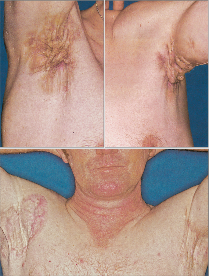 Folliculitis on the left lower breast and submammary area.