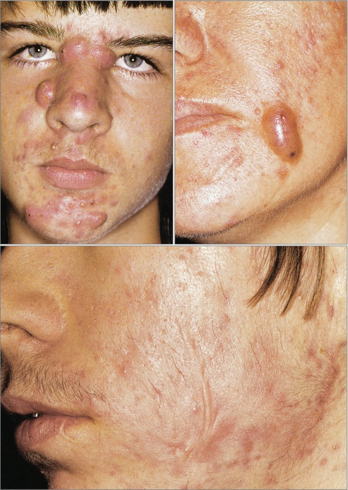 Acne Clinic: Morphogenesis | SpringerLink