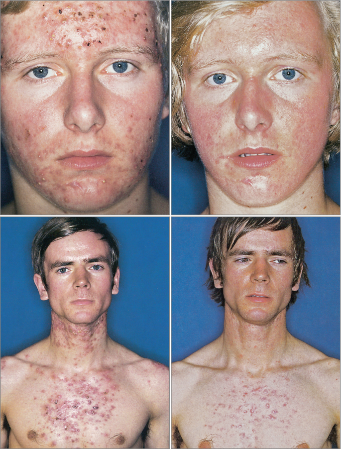 Acne Therapy | SpringerLink
