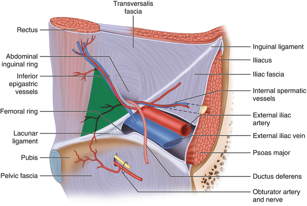 Inguinal hernia surgery - Wikipedia