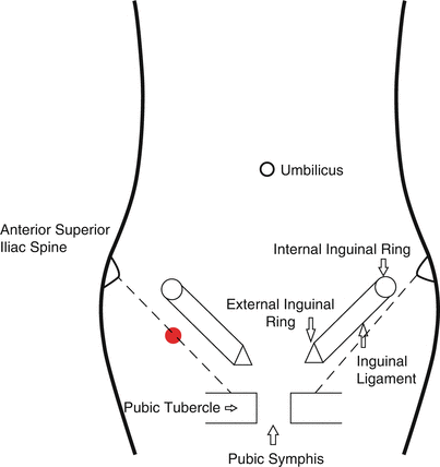 Evaluation of hernia of the male inguinal canal: sonographic method