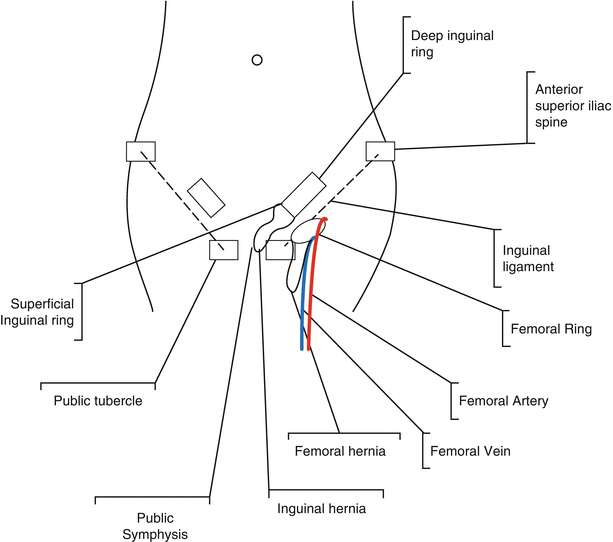 Femoral Hernia