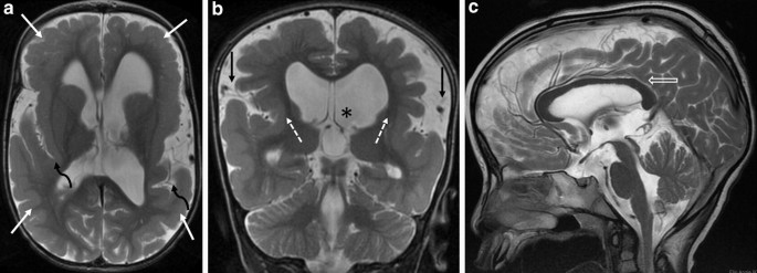 Neuroimaging Pathology In Cerebral Palsy Springerlink