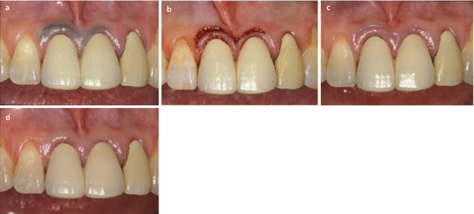 Impact of Laser Dentistry in Management of Color in Aesthetic Zone |  SpringerLink