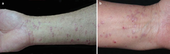 Cureus, Atypical Presentation of Scarlet Fever