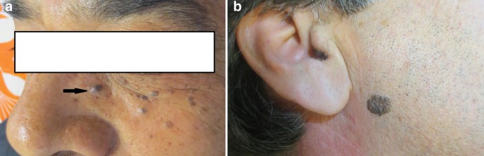 Freckles, Lentigos, Melanocytic Nevi, and Melanoma | Springer Nature Link