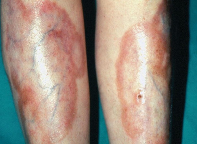 Inflammatory papulonodules and crusts on the inner thigh before the use
