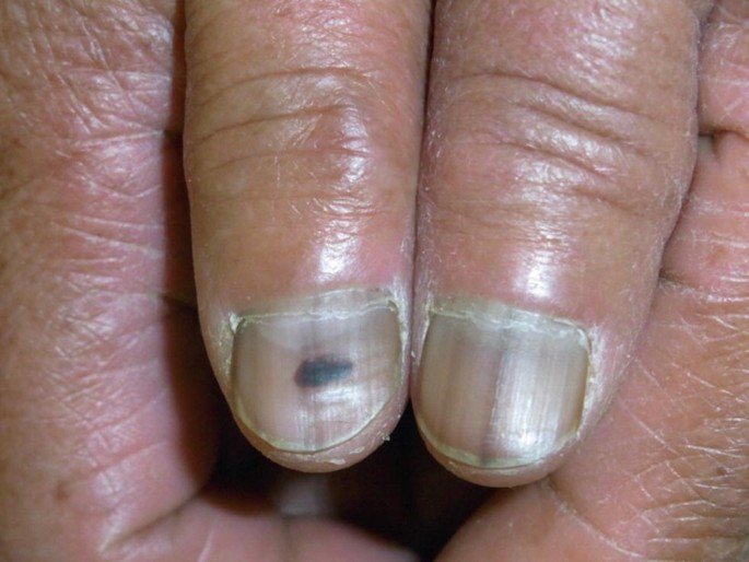 melanotic whitlow pictures Herpetic is a painful viral cutaneous infection that usually affects the distal fingers or thumbs, and occasionally the toes. It is caused by herpes simplex virus (HSV) type 1 or 2 Disorders of Nails | Springer