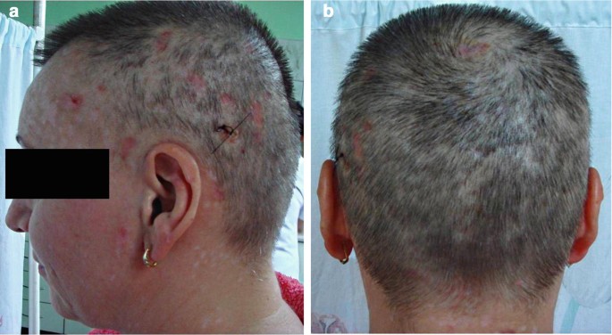 Disorders of Hair | SpringerLink Disorders of Hair | SpringerLink