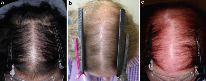 Scalp conditions: Examples, treatment, and pictures