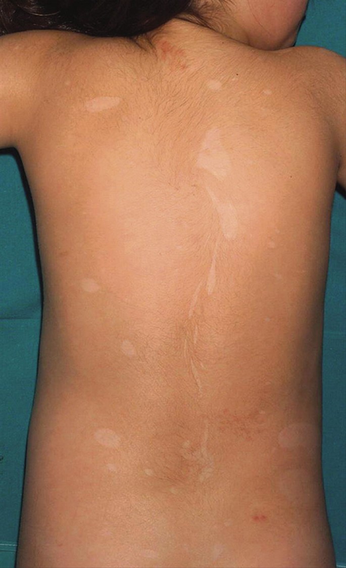 Medscape on X: The rash first appeared on the lower chest and inframammary  folds.  / X