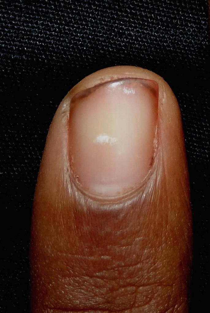 Nail Disorders in Patients with Chronic Renal Failure