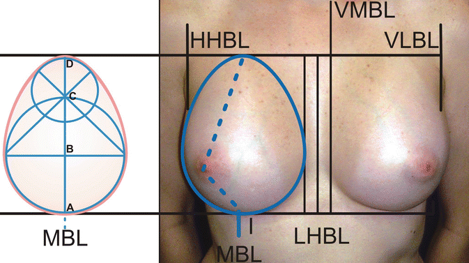 Breast Reduction with L Scar After 30 Years: Indications and
