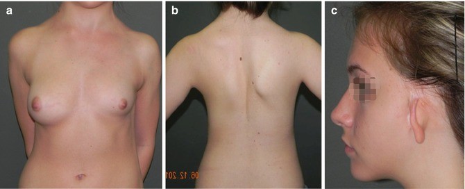 Asymmetrical Breasts Associated with Chest Deformities