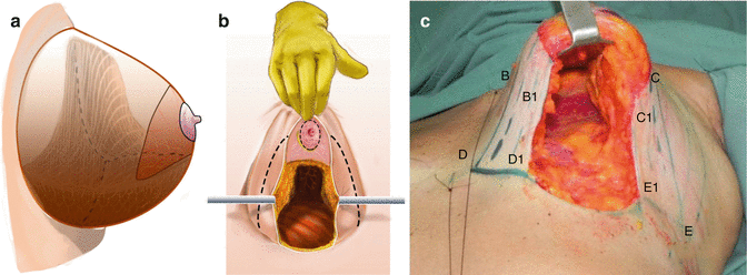 Concepts and Principles of Breast Reduction Surgery