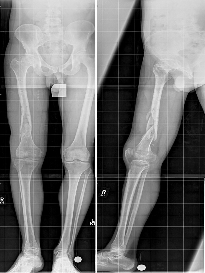 Ilizarov Surgery - Golden State Orthopedics & Spine