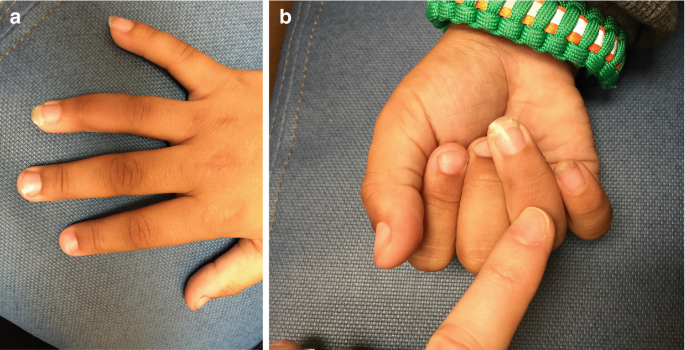 Do I Need Treatment For a Jammed Finger? | Gerald L. Yospur, M.D.