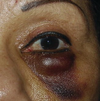 Eyelid Occlusion Dressing  Eye Occlusive Dressing & Bandages