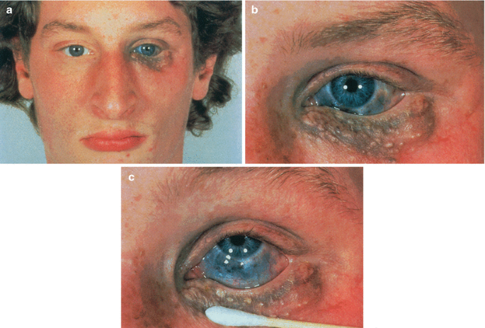 Benign Eyelid and Eye Growths > Fact Sheets > Yale Medicine