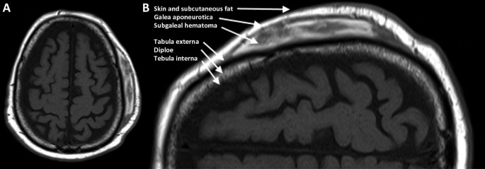 Traumatic Brain Injury: Imaging Strategy