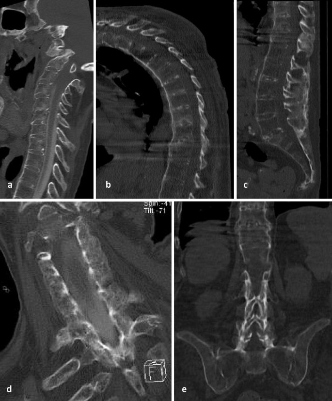 X Ray Dorso-lumbar Spine Lateral View shows bridging os