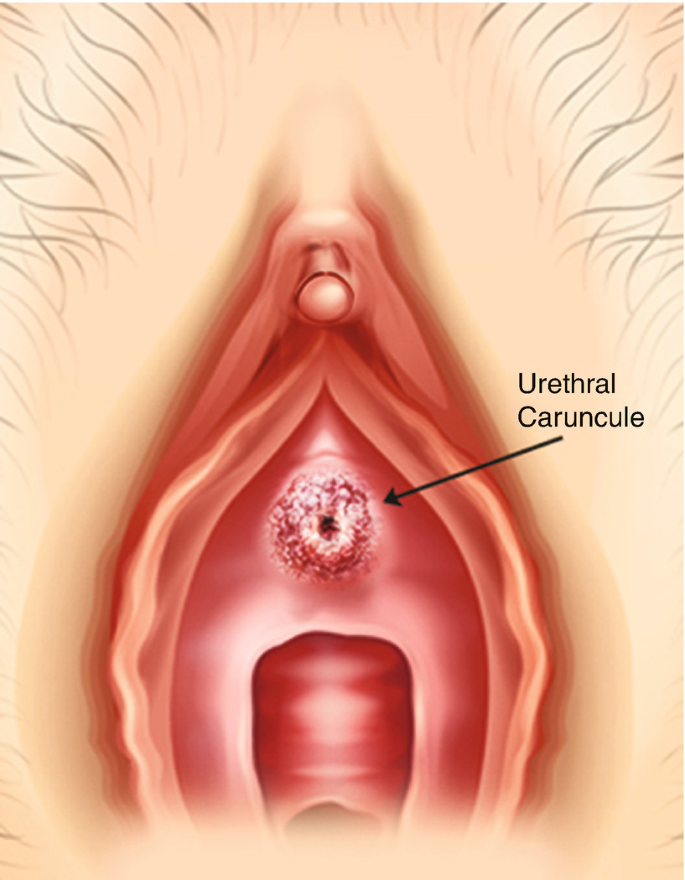 Urethral Mucosal Prolapse  Northeast Ohio Urogynecology
