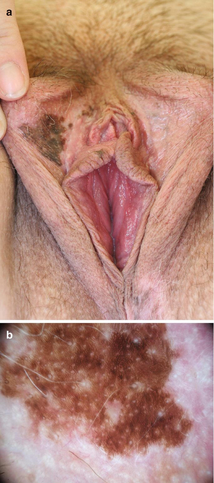 melanotic macules vulva Clinician's Update on the Benign, Premalignant, and Malignant Skin Tumours of the Vulva: The Dermatologist's View - Sand - 2017 - International Scholarly Research Notices Pigmentary Alterations and Benign Melanocytic