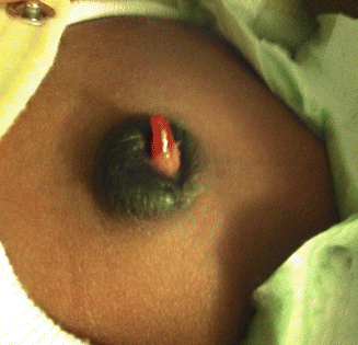 Umbilical Granuloma (UG)