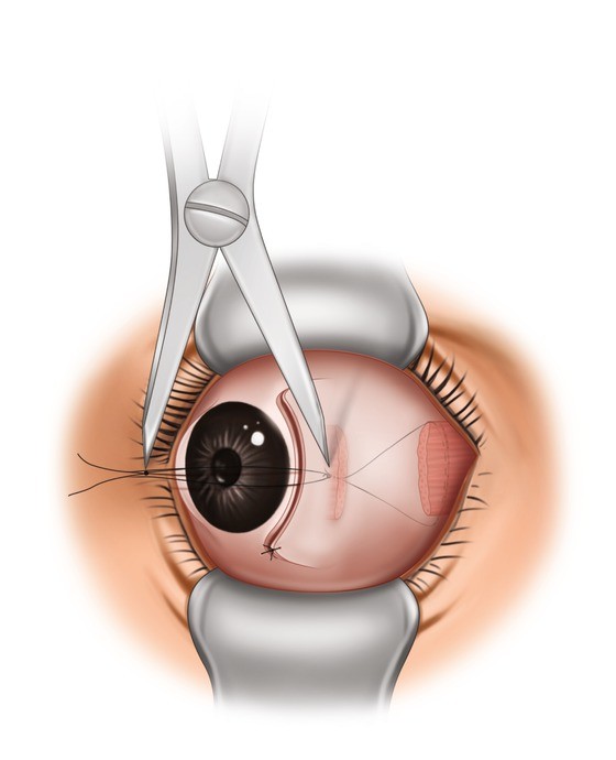 Strabismus Surgery | SpringerLink Strabismus Surgery | SpringerLink