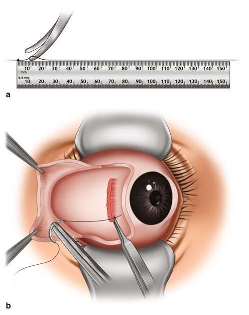 Strabismus Surgery | SpringerLink Strabismus Surgery | SpringerLink