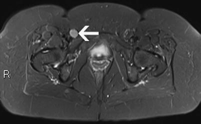 RadioGraphics on X: A groin lump is not uncommon in girls and