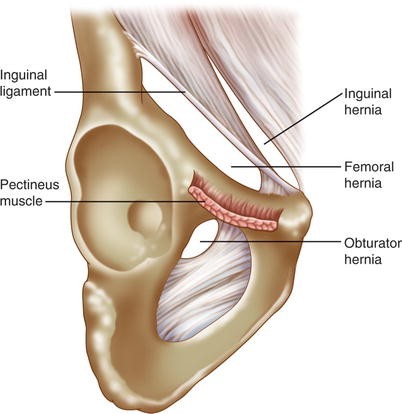 Breast Surgeon Dr Said Zaman Khan - •Femoral hernia locations. 1 ~Typical femoral  hernia. 2 ~Prevascular hernia. 3 ~External (lateral) hernia. 4 ~Lacunar  ligament hernia. 5 ~Pectineal hernia. 6 ~Retrovascular hernia. 𝗥𝗲𝗳:Hernia  Surgery, 5th ed, 2019