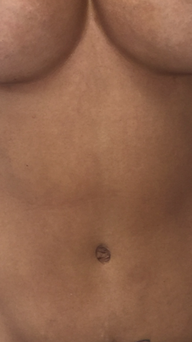 Umbilicoplasty in Bikini Form | SpringerLink
