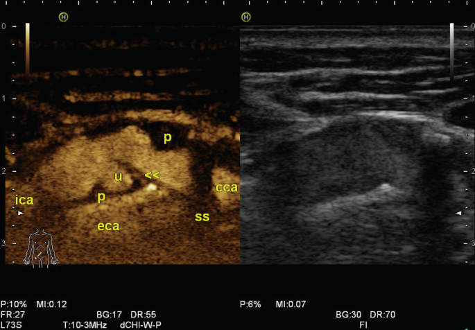 Extracranial Cerebral Arteries | SpringerLink Extracranial Cerebral Arteries | SpringerLink