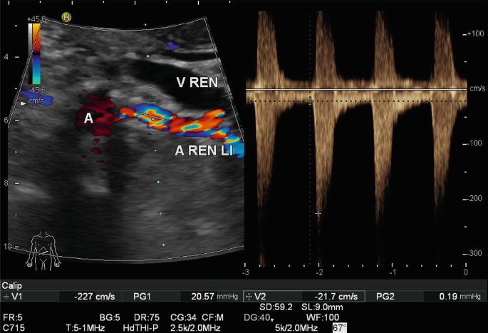 Visceral and Retroperitoneal Vessels