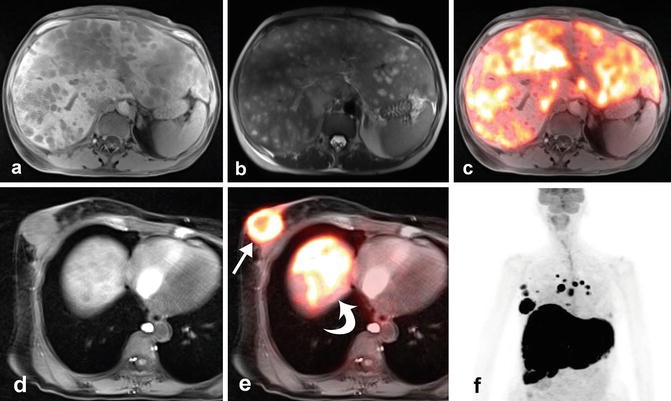 Metastatic Breast Cancer to the Liver | SpringerLink